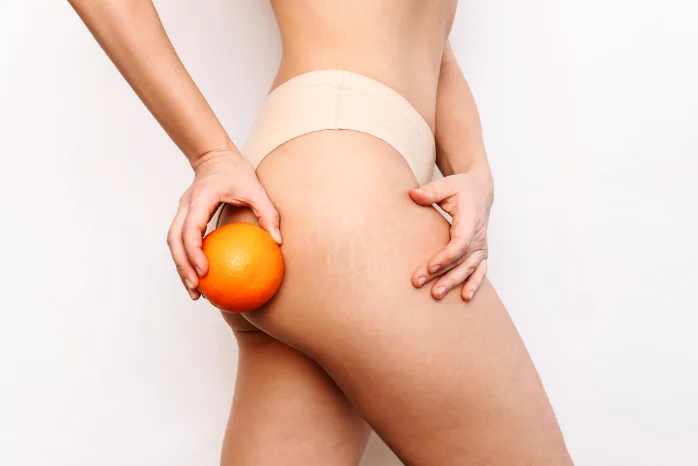 Celulitis