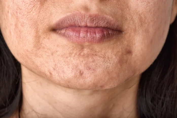 Cicatrices del Rostro