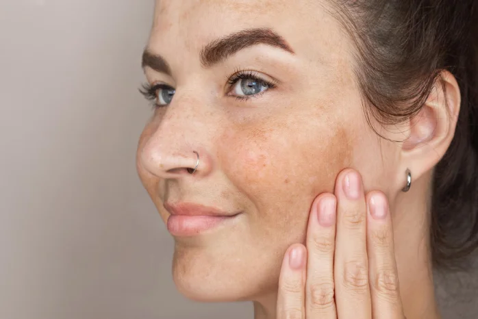 Manchas Oscuras (Melasma)